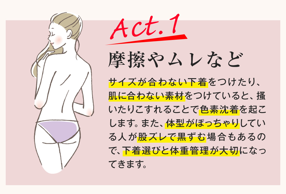 Act.1 摩擦やムレなど サイズが合わない下着をつけたり、
肌に合わない素材をつけていると、搔いたりこすれることで色素沈着を起こします。また、体型がぽっちゃりしている人が股ズレで黒ずむ場合もあるので、下着選びと体重管理が大切になってきます。