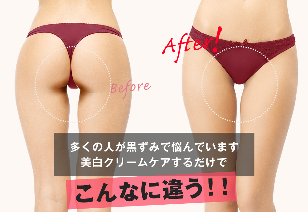 ビフォーアフター　多くの人が黒ずみで悩んでいます美白クリームケアするだけでこんなに違う！！